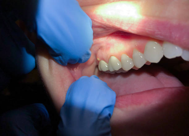 Best Dental Abscess Treatment in Culver, OR
